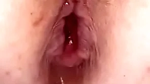 Anal burn out relating to my pest